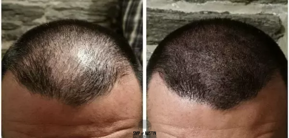 Opting for Scalp Micropigmentation? Make Sure you Know What to Look For!