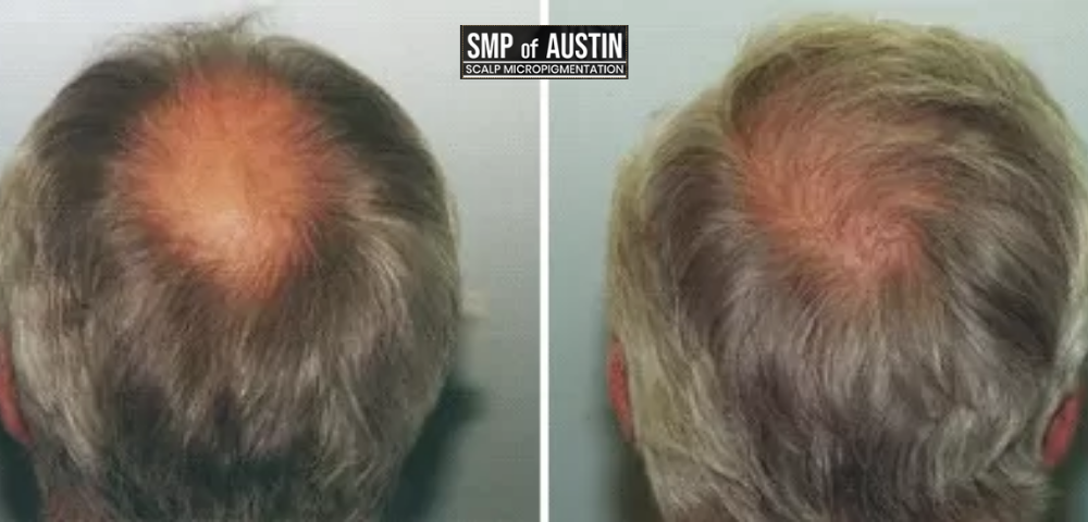hair loss treatment in Austin TX