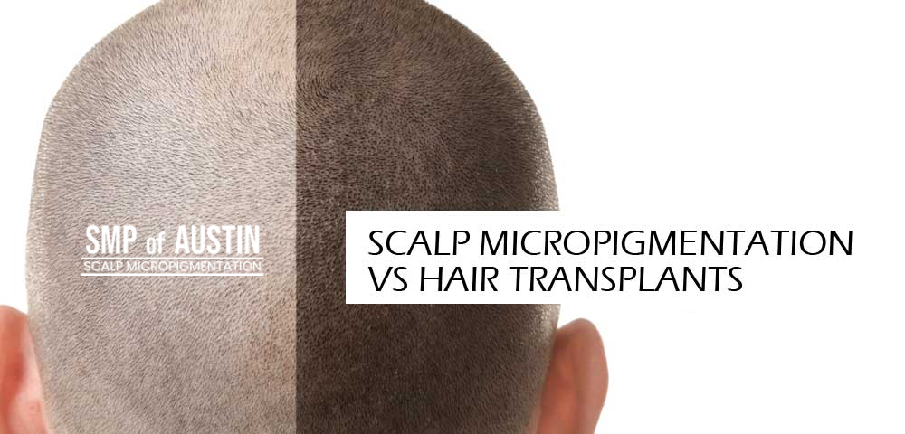 Hair Transplant vs. Scalp Micropigmentation 