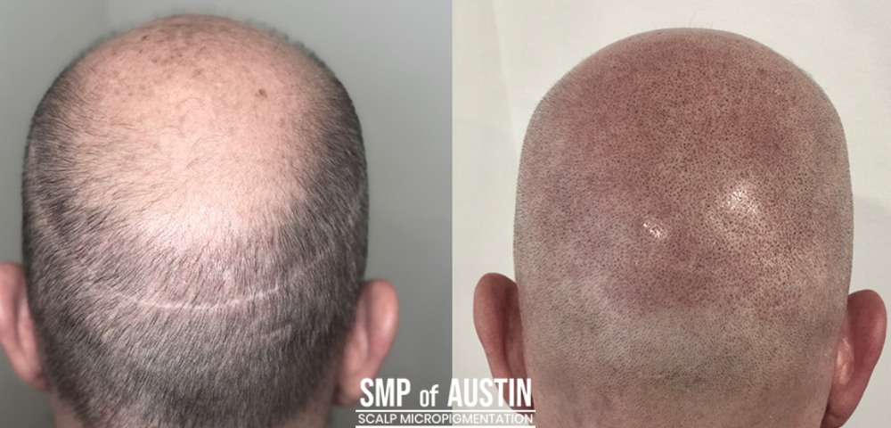 Using Scalp Micropigmentation to Cover Head Scars