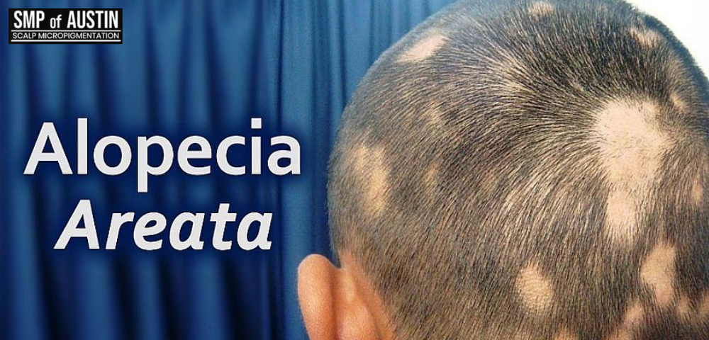 alopecia areata treatment in Austin TX.