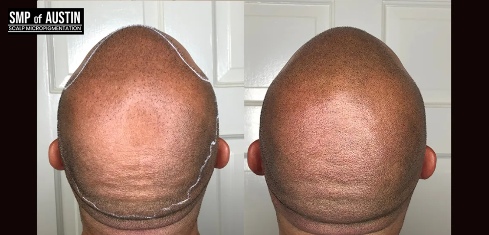 The Best & Most Reliable Hair Loss Treatment with Scalp Micropigmentation in Austin