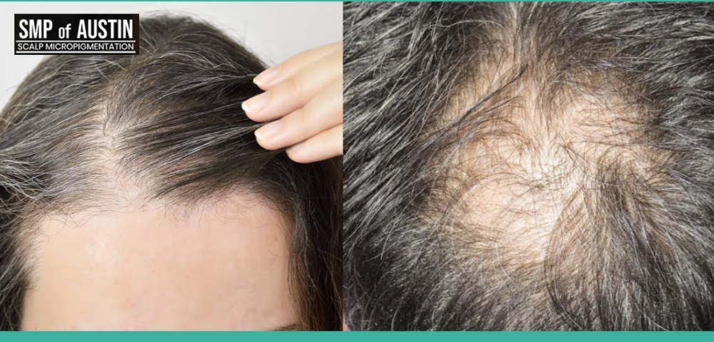 Treating Female Pattern Hair Loss with SMP