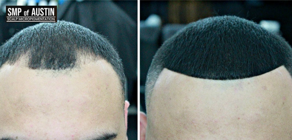 Bald Spot Coverage Treatment for Women with Scalp Micropigmentation