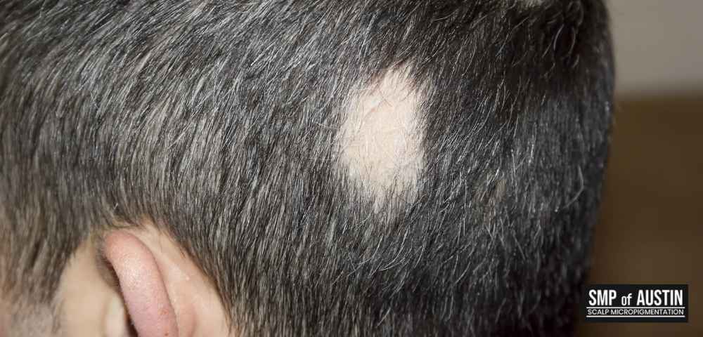 Scalp Micropigmentation for Alopecia Areata Treatment