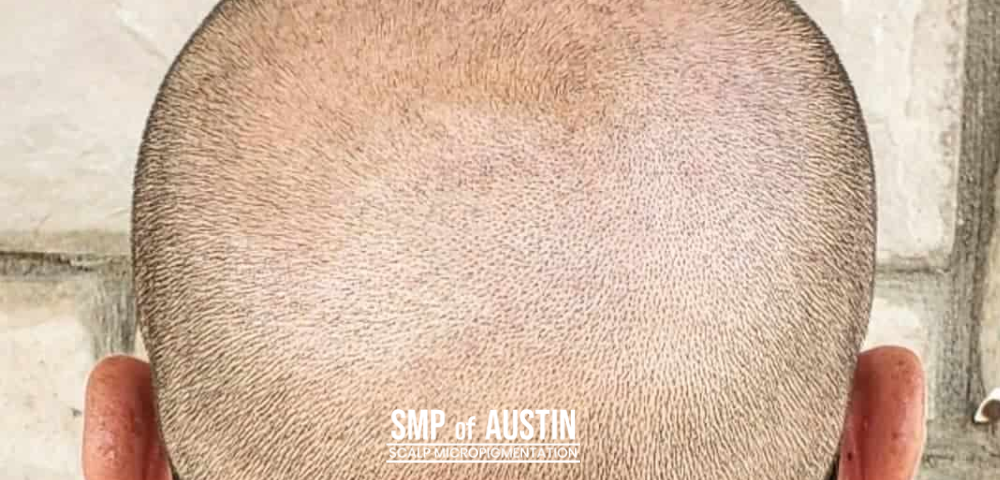 Why Use Scalp Micropigmentation to Cover Your Scars?