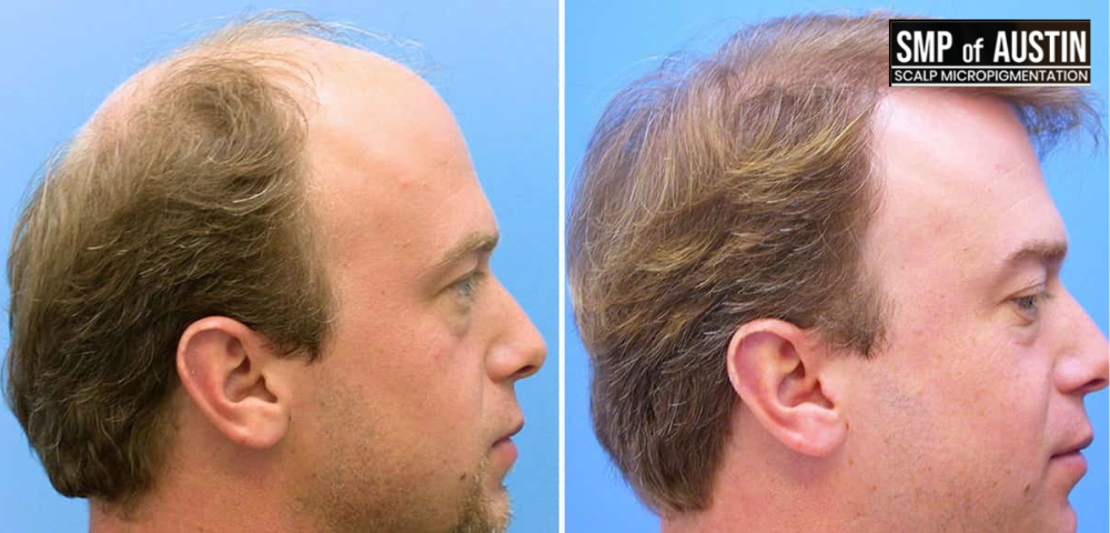 The Pros & Cons of Hair Transplantation versus Scalp Micropigmentation