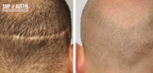 Regain Your Hairline Effective Male Pattern Baldness Treatment in Austin, TX